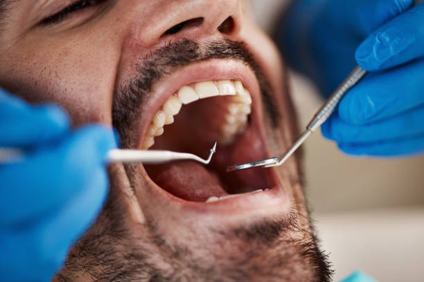 Best Emergency Wisdom Tooth Extraction in Warrior, AL